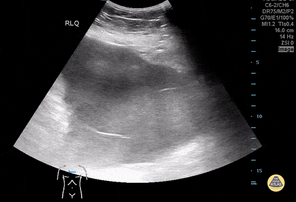 Bowel-GI - Complex Ascites