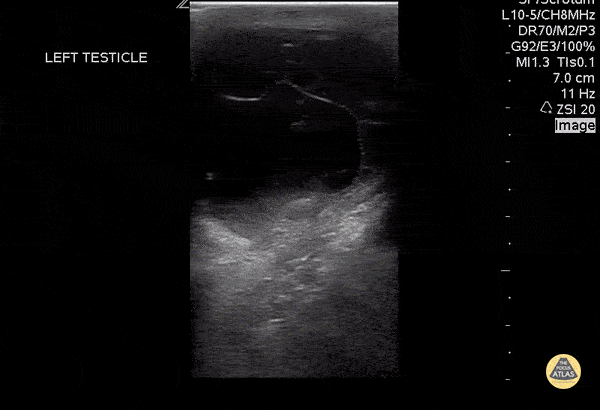 Renal/GU - Septated Hydrocele