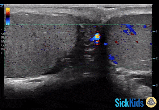 Pediatrics - Testicular Torsion