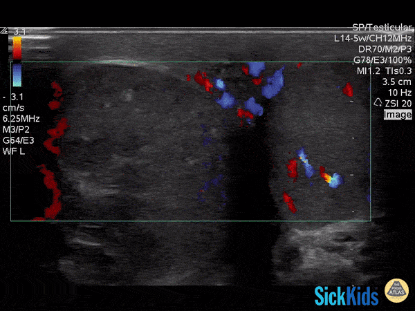 Pediatrics - Testicular Torsion