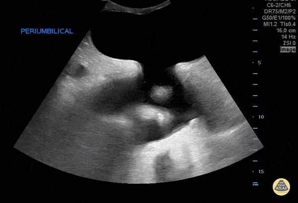 Bowel-GI - Fluid Filled Periumbilical Hernia