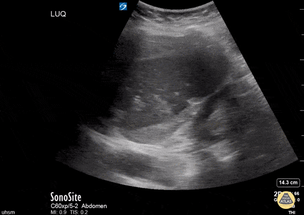 Bowel-GI - Perisplenic Hematoma