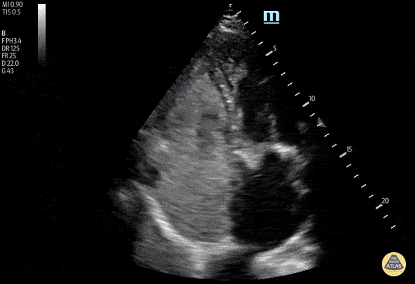 Right Ventricular Dysfunction - Post Traumatic Arrest Echo with RA/RV Thrombus