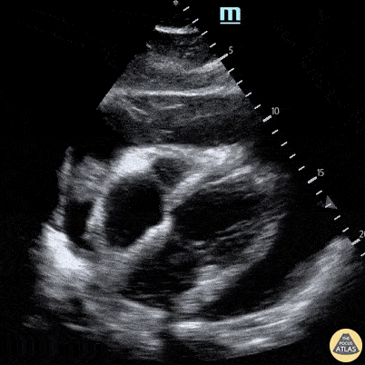 Pericardial Disease - Pericardial Effusion and Rapid Atrial Fibrillation