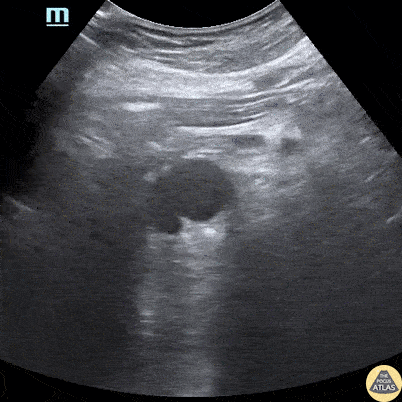 Aorta - Abdominal Aortic Dissection Flap