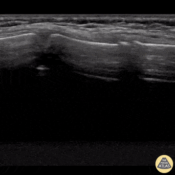 Musculoskeletal - Sternal fracture
