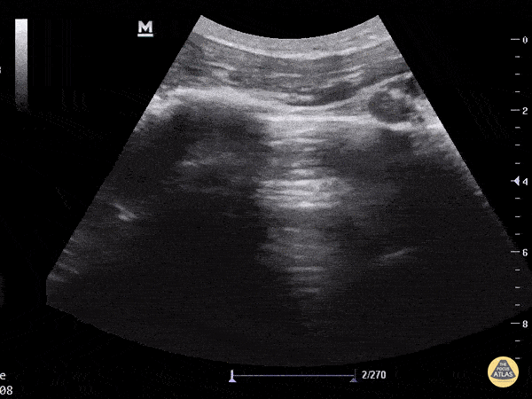 Pulmonary - Improve Lung Sliding Visualization