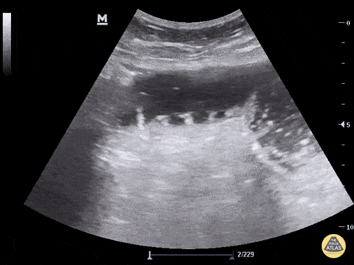 Bowel-GI - The Keyboard Sign