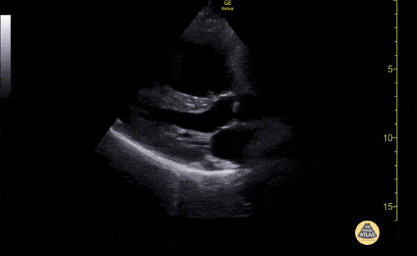 Right Ventricular Dysfunction - Right Ventricular Enlargement in Chronic COPD