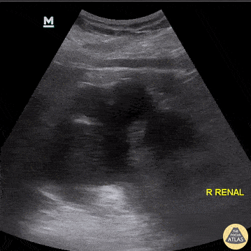 Renal/GU - Hydronephrosis