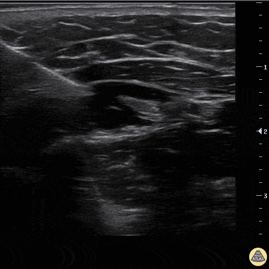 Nerve Block Gallery - Radial Nerve Block
