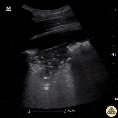 Pulmonary - Classic Findings in Pneumonia