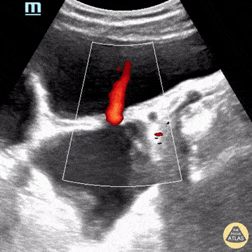 Renal/GU - Diverticuli of Urinary Bladder