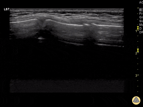 Peds-MSK - Sternal Fracture