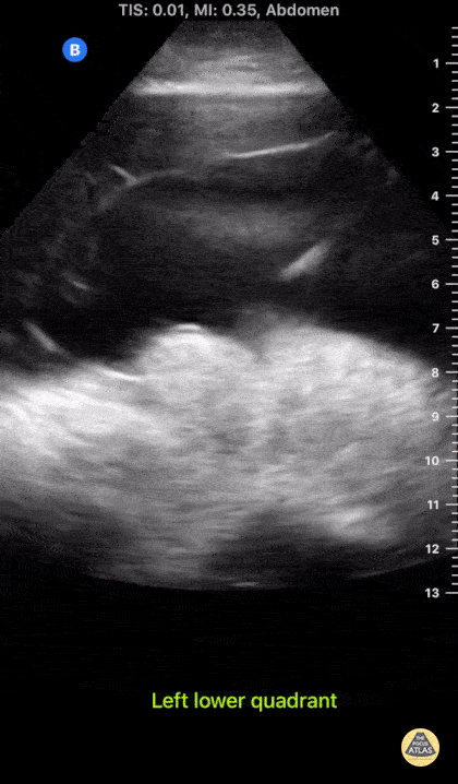 Bowel-GI - Fibrinous Ascites