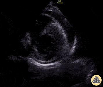 Pericardial Disease - Pericardial Effusion in Parasternal Short-Axis