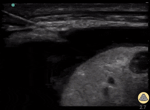 Pericardial Disease - Pericardiocentesis
