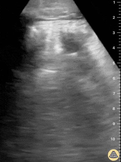 Pulmonary - Ultrasound Findings in Pulmonary Contusion