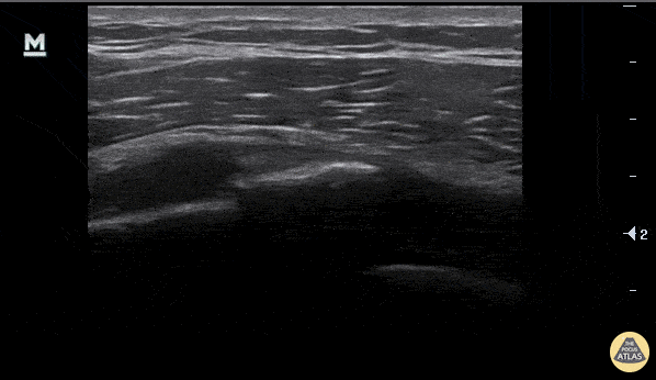Musculoskeletal - Rib Fracture