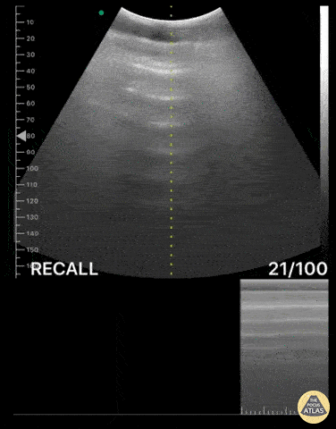 Bowel-GI - Pneumoperitoneum with Enhanced Peritoneal Stripe Sign