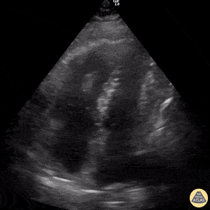 EA Echo Examples - RV Thrombus & McConnell's Sign