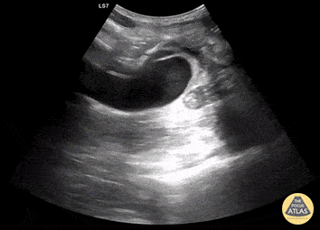 Aorta - Aortic Endograft Leak Long Axis