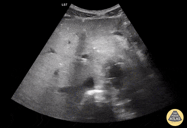 Aorta - Aortic Endograft Leak - Transverse