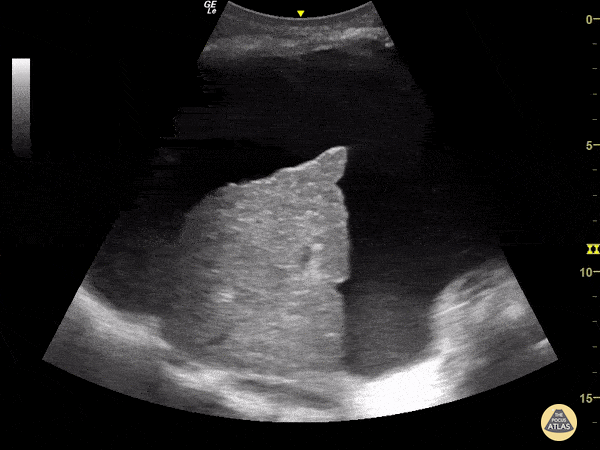 Bowel-GI - Cirrhosis