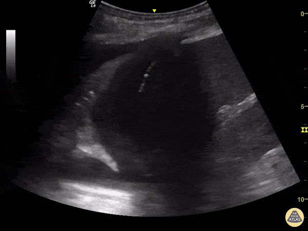 Pulmonary - Jellyfish Sign
