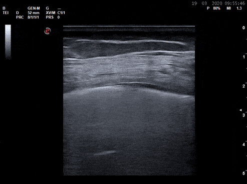 Pulmonary - Common Pleural Based Findings in COVID-19
