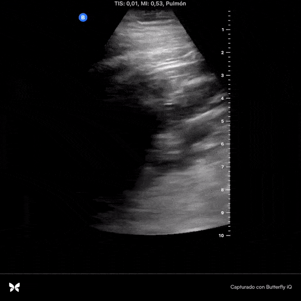 COVID 19 Lung US Disease Progression - Day 1