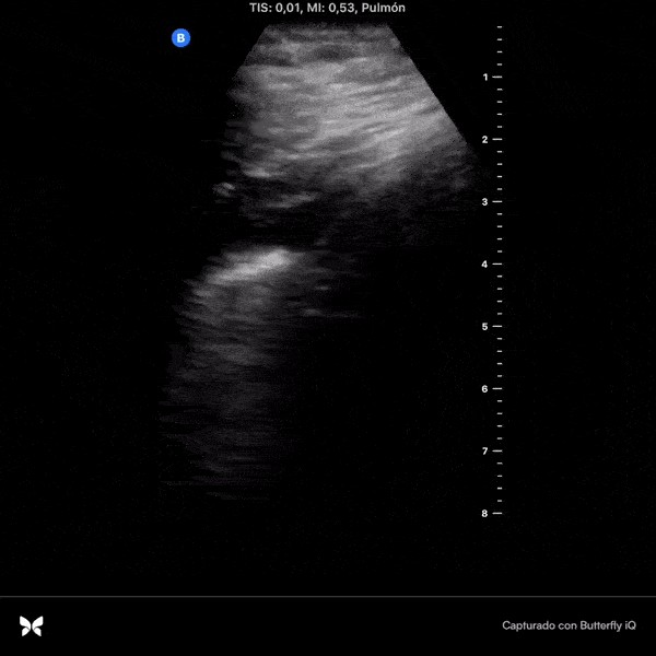COVID 19 Lung US Disease Progression - Day 2