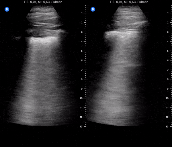 COVID 19 Lung US Disease Progression - Day 5