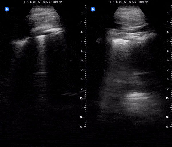 COVID 19 Lung US Disease Progression - Day 6