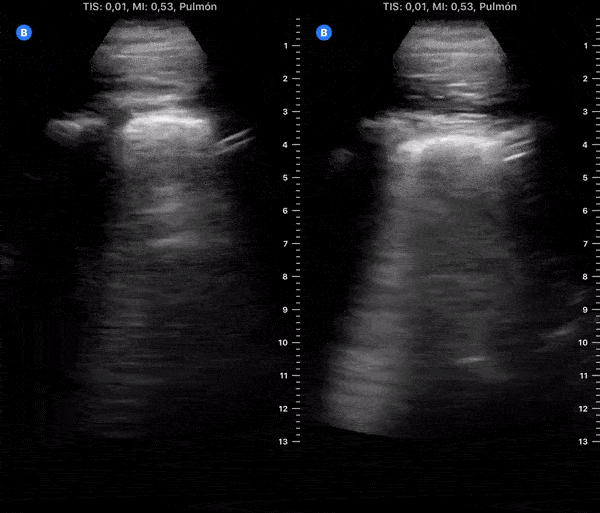 COVID 19 Lung US Disease Progression - Day 7