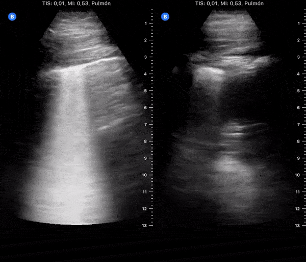 COVID 19 Lung US Disease Progression - Day 8