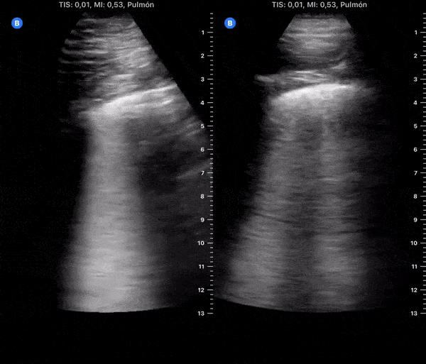 COVID 19 Lung US Disease Progression - Day 9