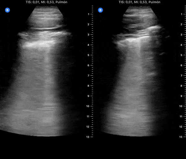 COVID 19 Lung US Disease Progression - Day 10