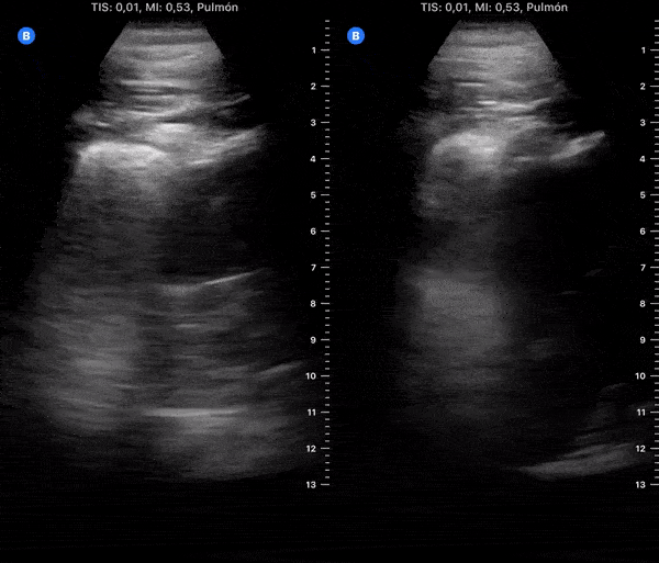 COVID 19 Lung US Disease Progression - Day 11