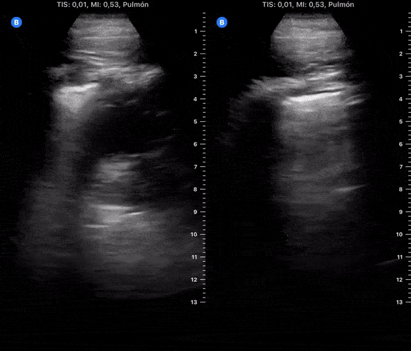 COVID 19 Lung US Disease Progression - Day 12