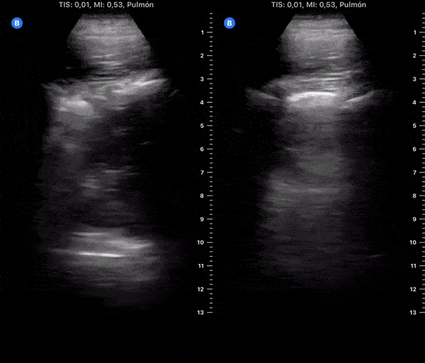 COVID 19 Lung US Disease Progression - Day 13