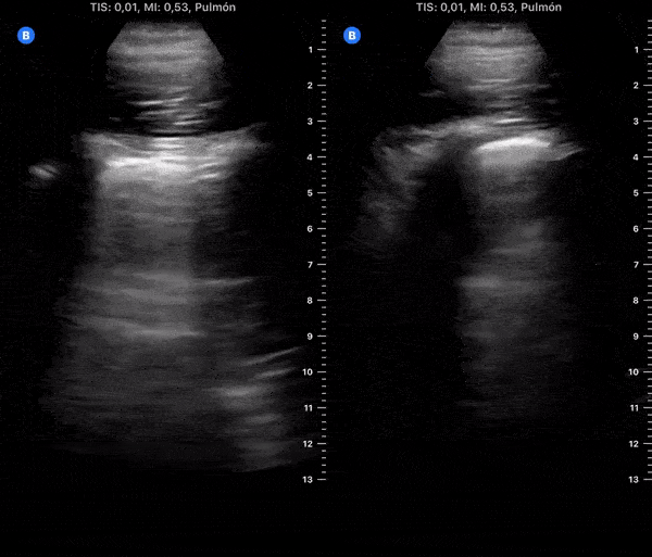 COVID 19 Lung US Disease Progression - Day 14
