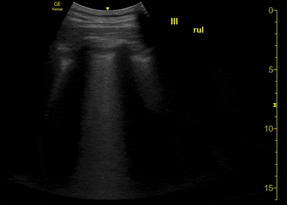 Pulmonary - A COVID-19 Patient with 3 days of Symptoms [1/3]