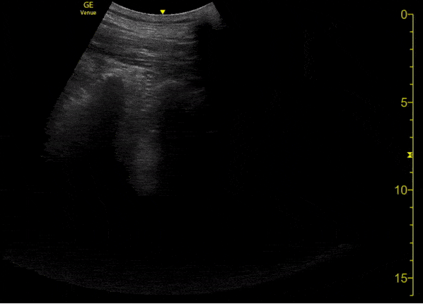 Pulmonary - A COVID-19 Patient with 3 days of Symptoms [2/3]
