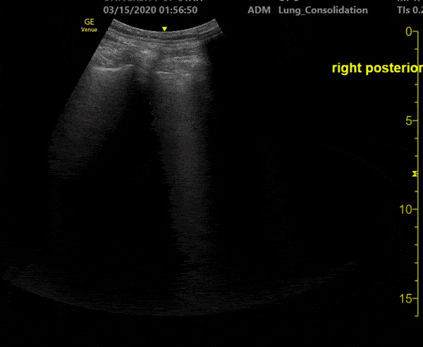 Pulmonary - A COVID-19 Patient with 3 days of Symptoms [3/3]
