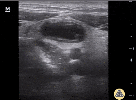 Bowel-GI - Pediatric appendicitis