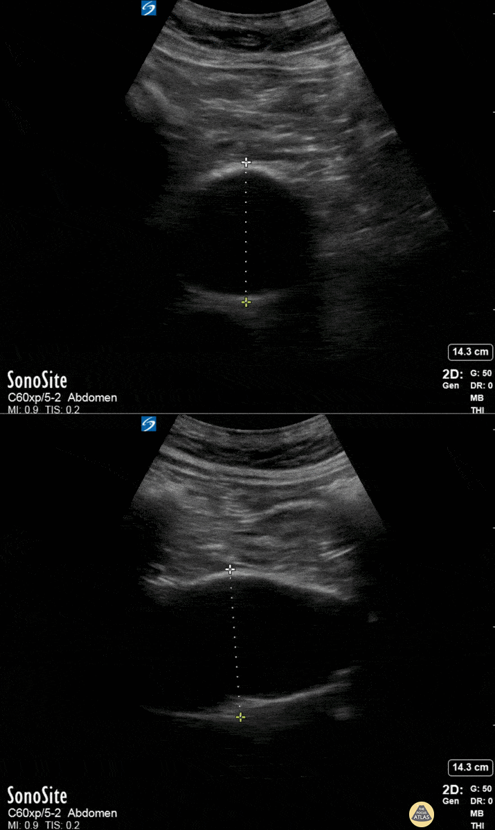 Aorta - Incidental AAA