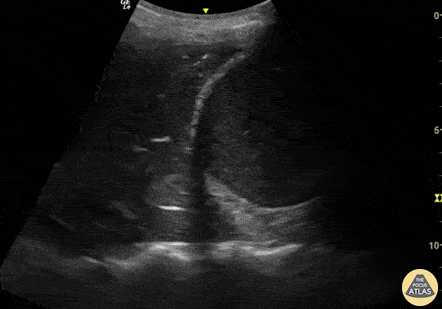Pulmonary - PLAPS pneumonia