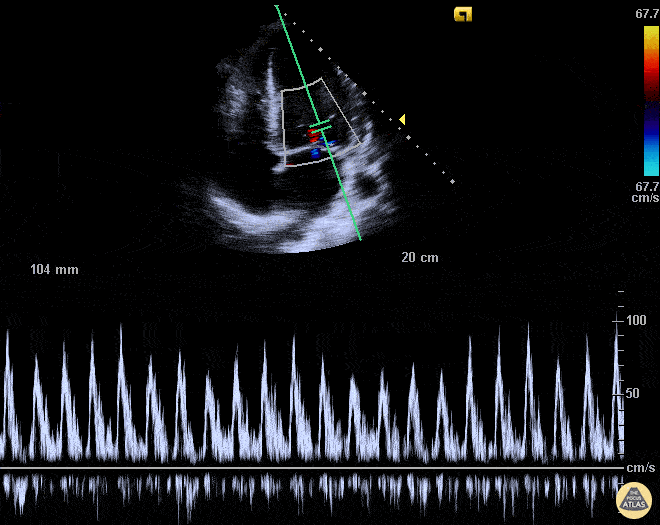 Valvulopathy - MV Inflow Variation