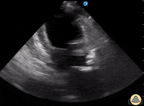 Left Ventricular Dysfunction - LV Failure